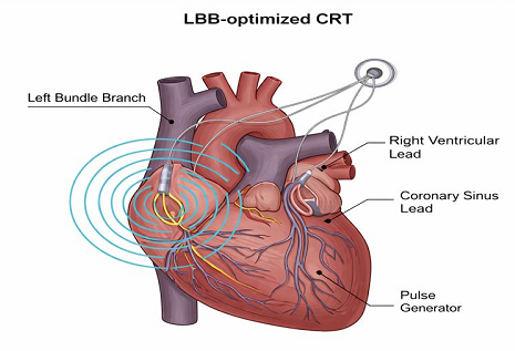 Left bundle branch–optimized cardiac resynchronization therapy